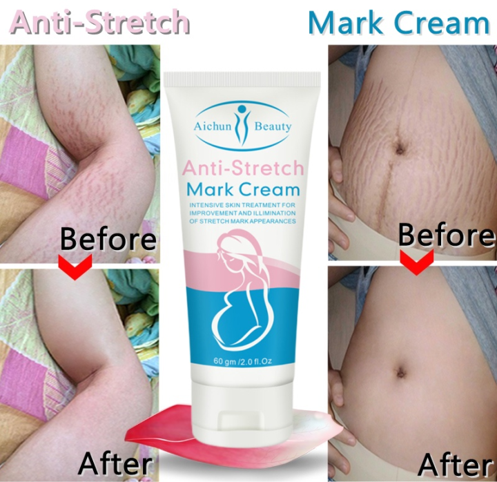 Anti-Stretch Mark Cream Remove Stretch Marks Moisturizing Nourishing Remove Cellulite Improve Rough Brighten Skin Tone Skin Care